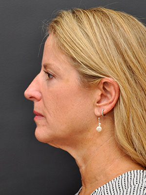 Natural Mini Facelift Before and After | Northside Plastic Surgery