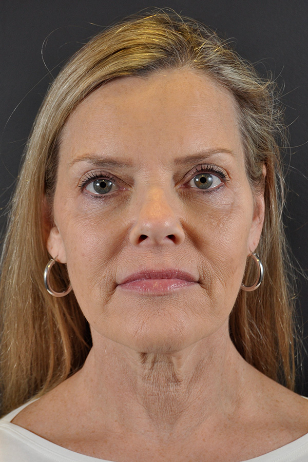 Natural Mini Facelift Before and After | Northside Plastic Surgery