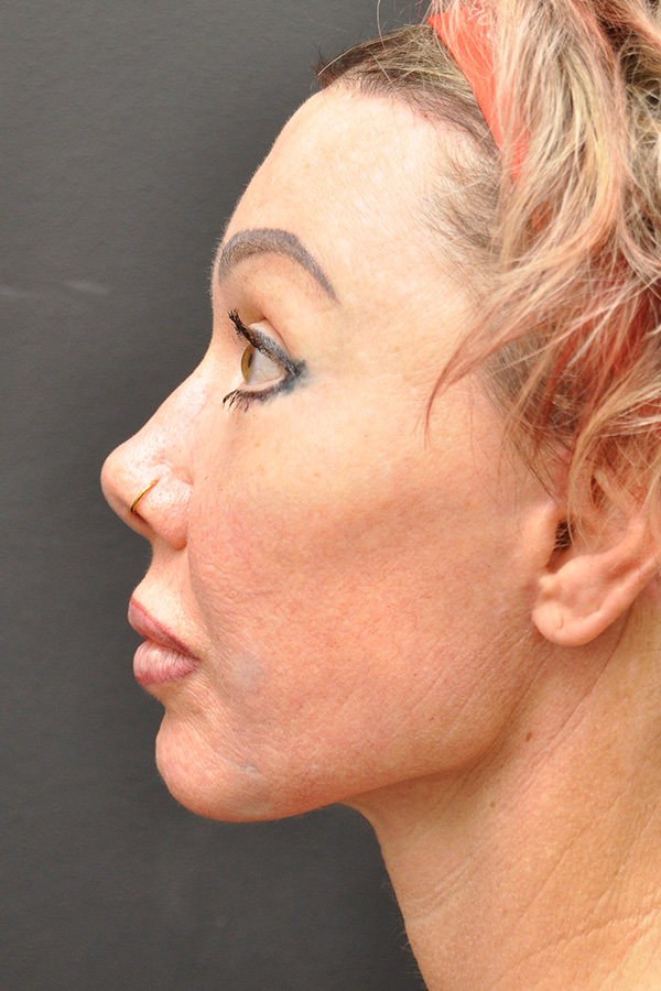 Natural Mini Facelift Before and After | Northside Plastic Surgery