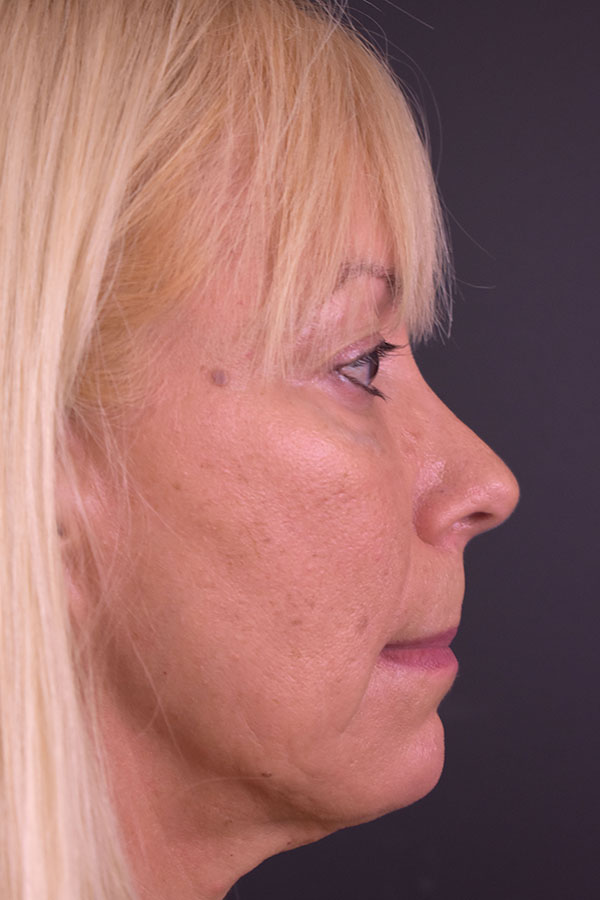 Natural Mini Facelift Before and After | Northside Plastic Surgery