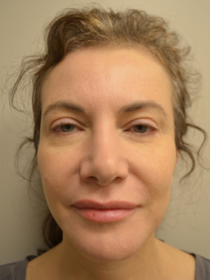 Natural Mini Facelift Before and After | Northside Plastic Surgery