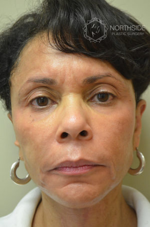 Natural Mini Facelift Before and After | Northside Plastic Surgery