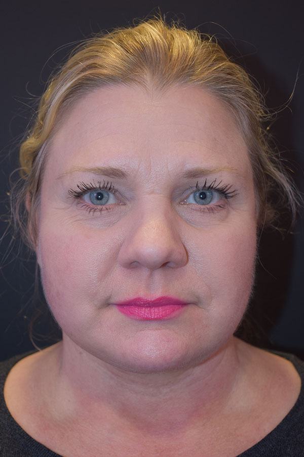 Natural Mini Facelift Before and After | Northside Plastic Surgery