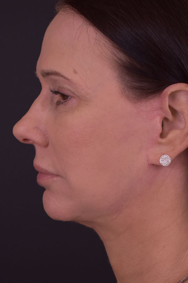 Natural Mini Facelift Before and After | Northside Plastic Surgery