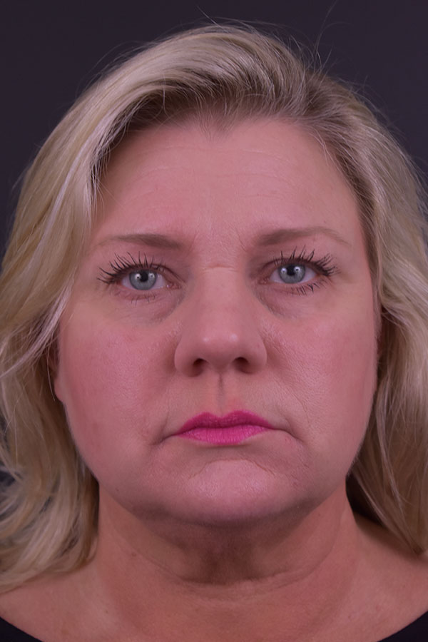 Natural Mini Facelift Before and After | Northside Plastic Surgery