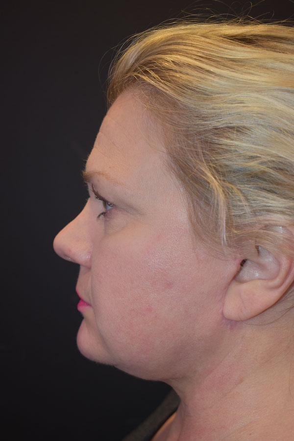 Natural Mini Facelift Before and After | Northside Plastic Surgery