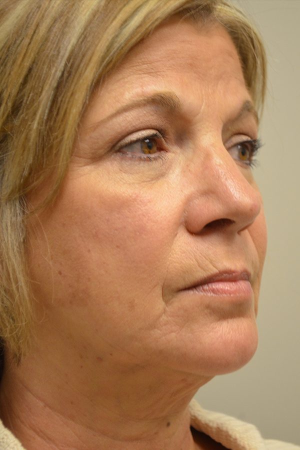 Natural Mini Facelift Before and After | Northside Plastic Surgery