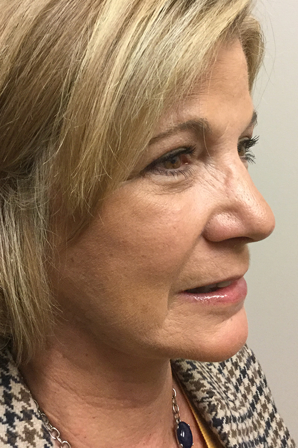 Natural Mini Facelift Before and After | Northside Plastic Surgery