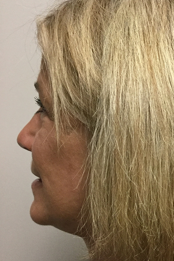 Natural Mini Facelift Before and After | Northside Plastic Surgery