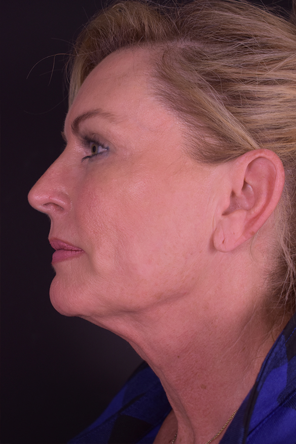 Natural Mini Facelift Before and After | Northside Plastic Surgery