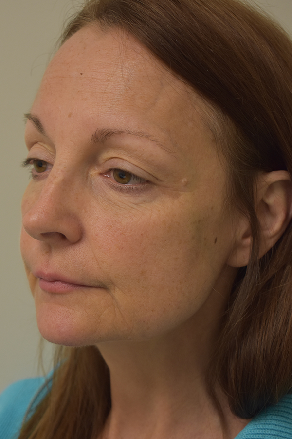 Natural Mini Facelift Before and After | Northside Plastic Surgery