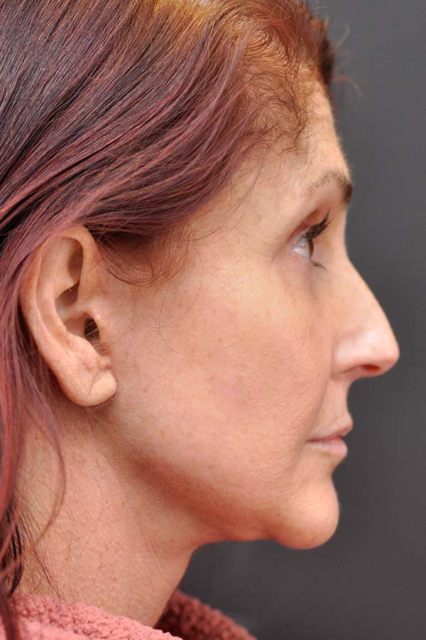 Natural Mini Facelift Before and After | Northside Plastic Surgery