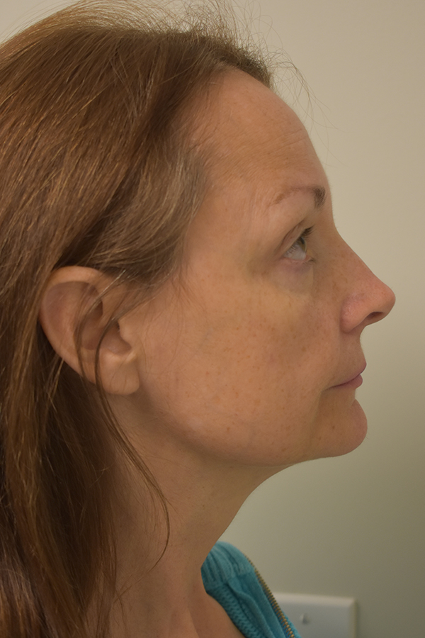 Natural Mini Facelift Before and After | Northside Plastic Surgery