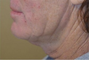 Natural Mini Necklift Before and After | Northside Plastic Surgery