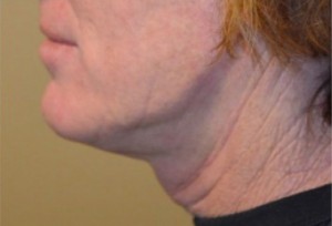 Natural Mini Necklift Before and After | Northside Plastic Surgery