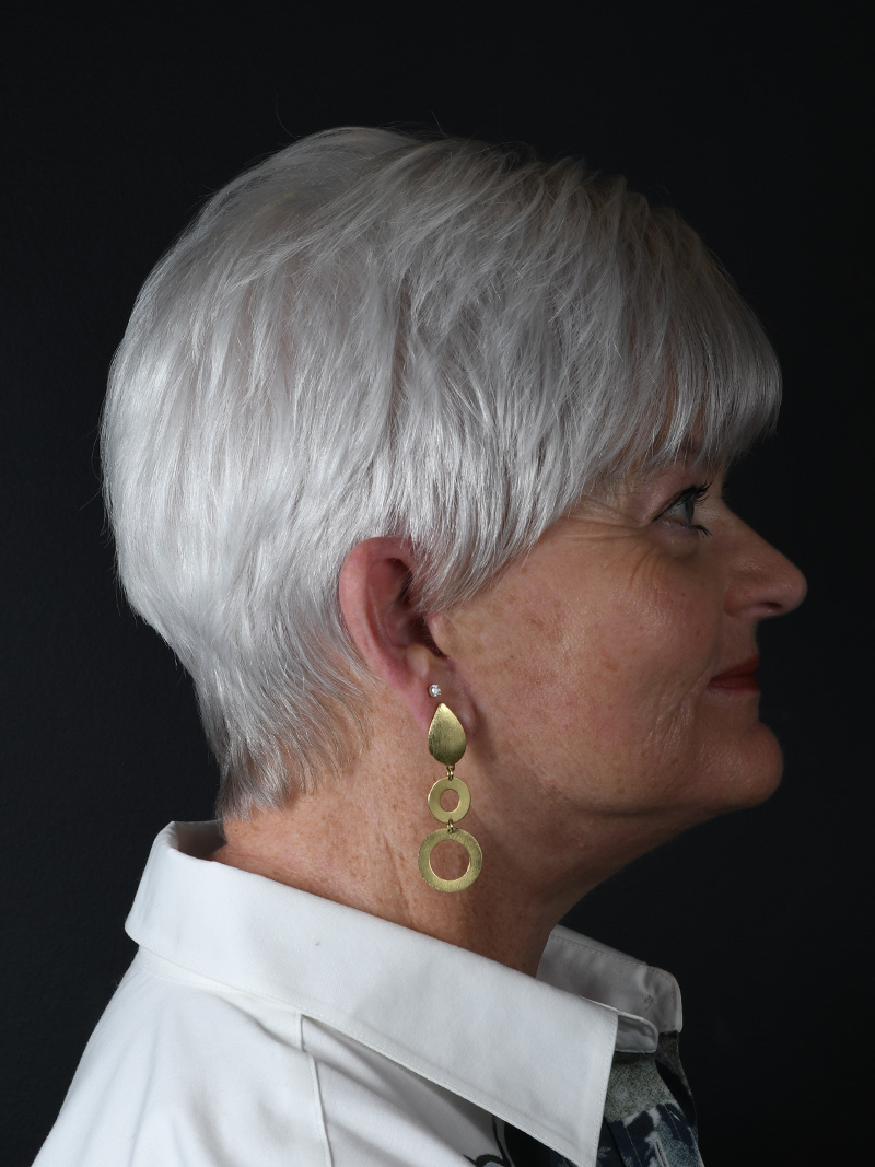 Natural Neck Lift Before and After | Northside Plastic Surgery