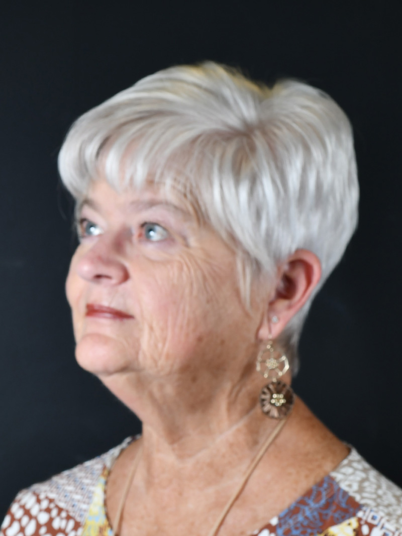 Natural Neck Lift Before and After | Northside Plastic Surgery