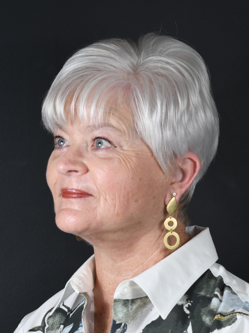 Natural Neck Lift Before and After | Northside Plastic Surgery