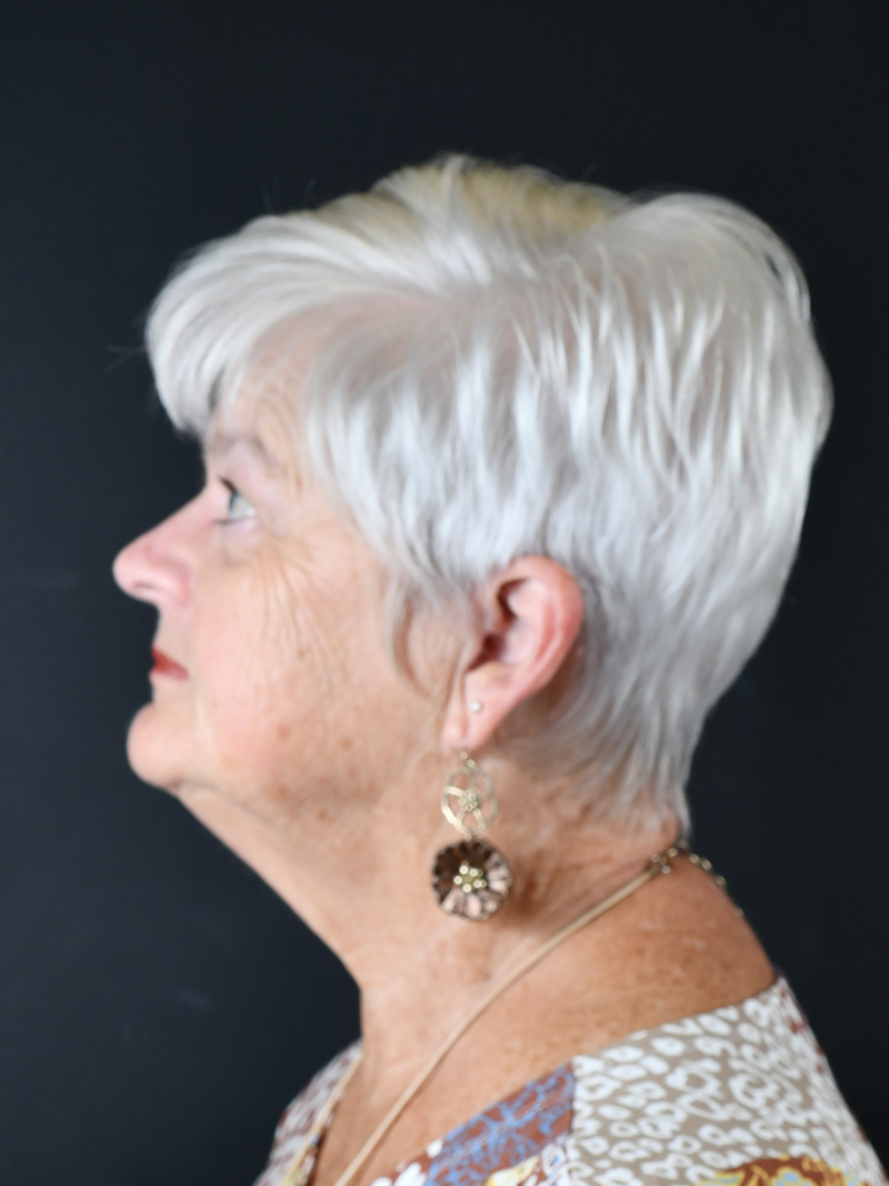 Natural Neck Lift Before and After | Northside Plastic Surgery