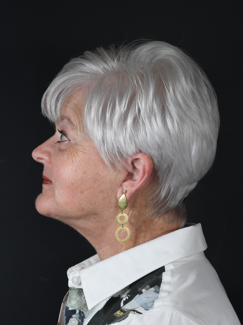 Natural Neck Lift Before and After | Northside Plastic Surgery