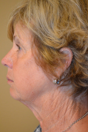 Natural Neck Lift Before and After | Northside Plastic Surgery