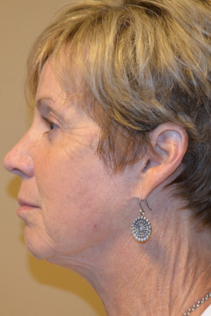 Natural Neck Lift Before and After | Northside Plastic Surgery