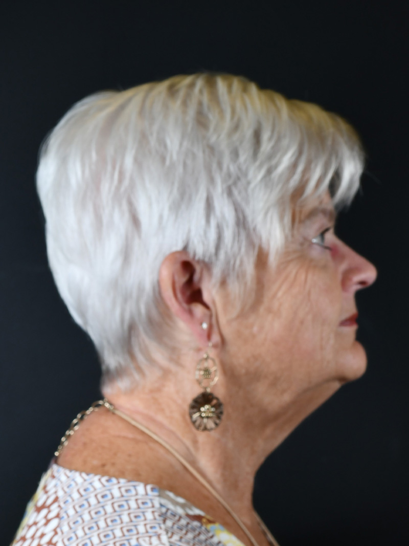 Natural Neck Lift Before and After | Northside Plastic Surgery
