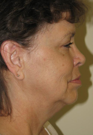 Natural Neck Lift Before and After | Northside Plastic Surgery