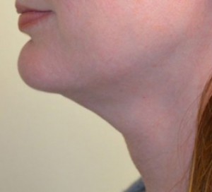 Natural Neck Lift Before and After | Northside Plastic Surgery