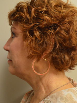 Natural Neck Lift Before and After | Northside Plastic Surgery