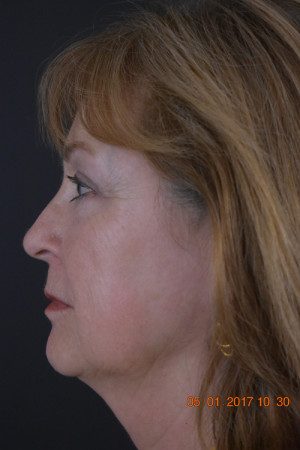 Natural Neck Lift Before and After | Northside Plastic Surgery