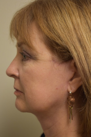 Natural Neck Lift Before and After | Northside Plastic Surgery