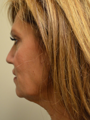 Natural Neck Lift Before and After | Northside Plastic Surgery