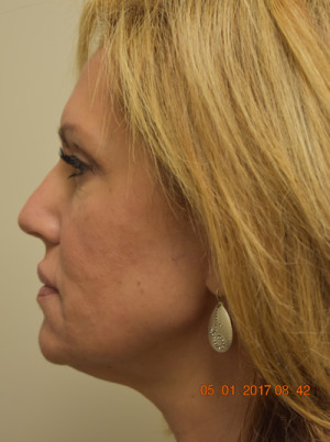 Natural Neck Lift Before and After | Northside Plastic Surgery