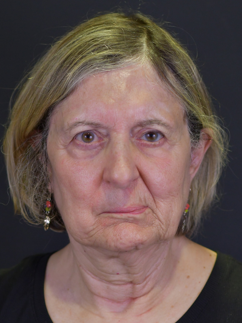 Neck Liposuction Before and After | Northside Plastic Surgery