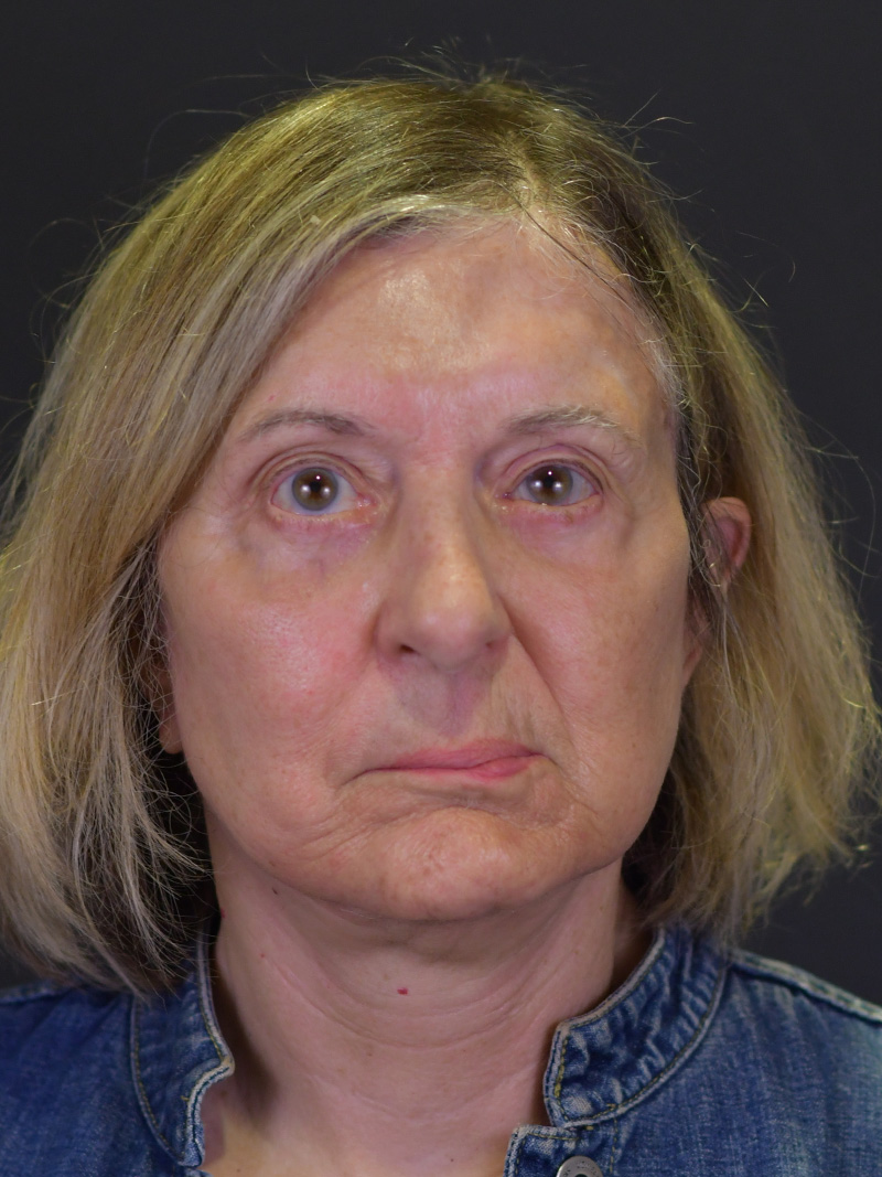 Neck Liposuction Before and After | Northside Plastic Surgery