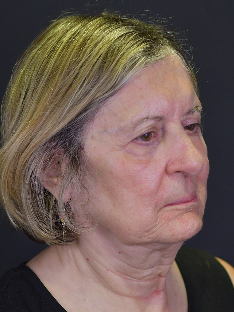 Neck Liposuction Before and After | Northside Plastic Surgery