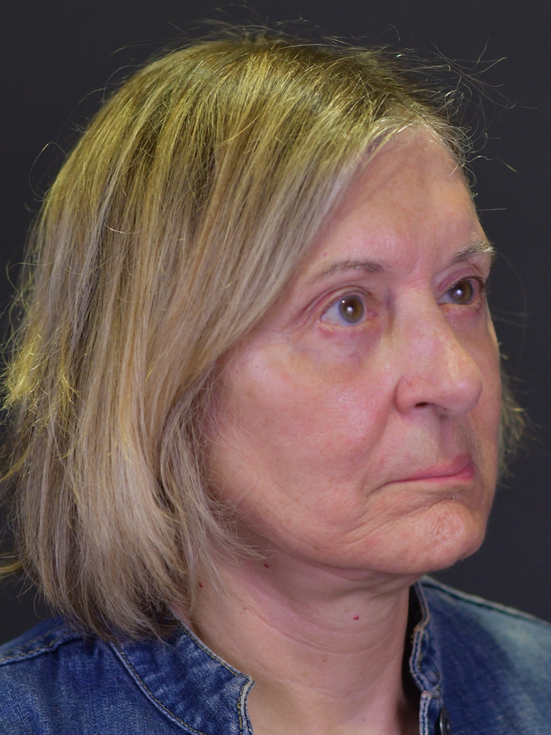 Neck Liposuction Before and After | Northside Plastic Surgery