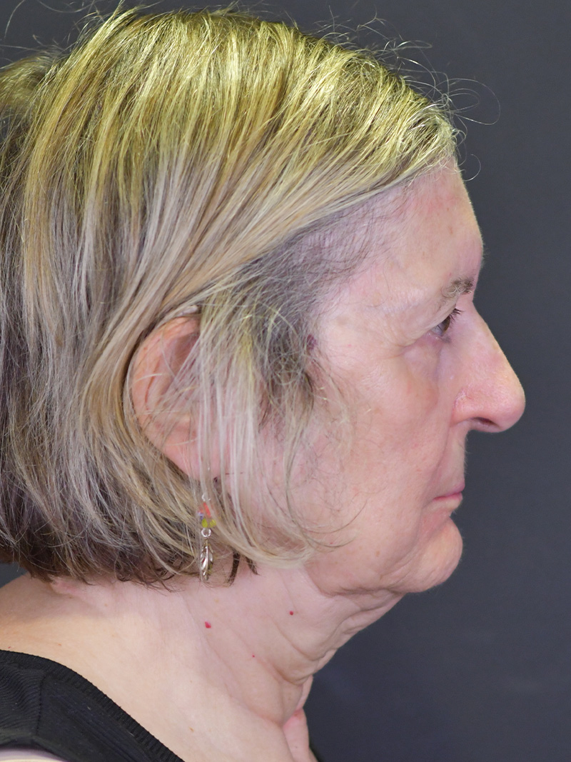 Neck Liposuction Before and After | Northside Plastic Surgery