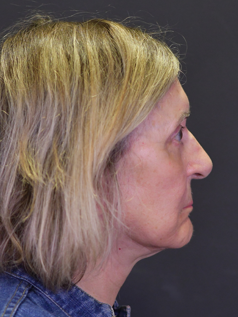 Neck Liposuction Before and After | Northside Plastic Surgery