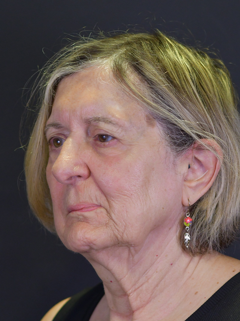 Neck Liposuction Before and After | Northside Plastic Surgery