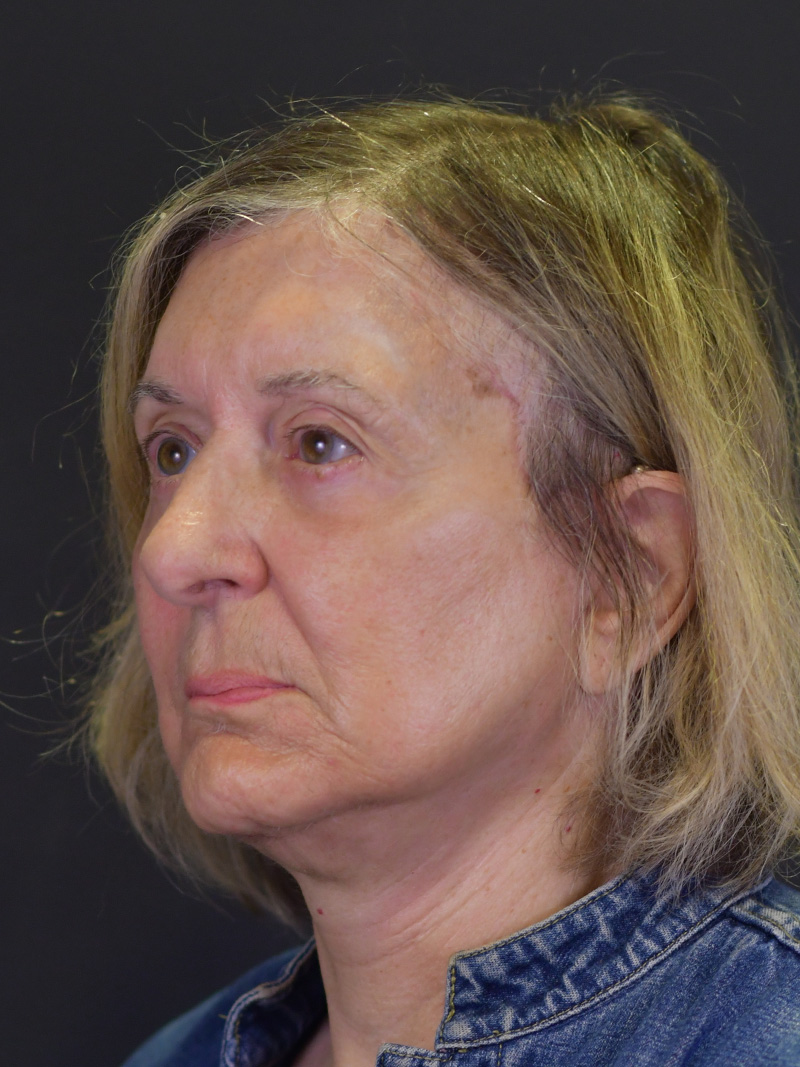 Neck Liposuction Before and After | Northside Plastic Surgery