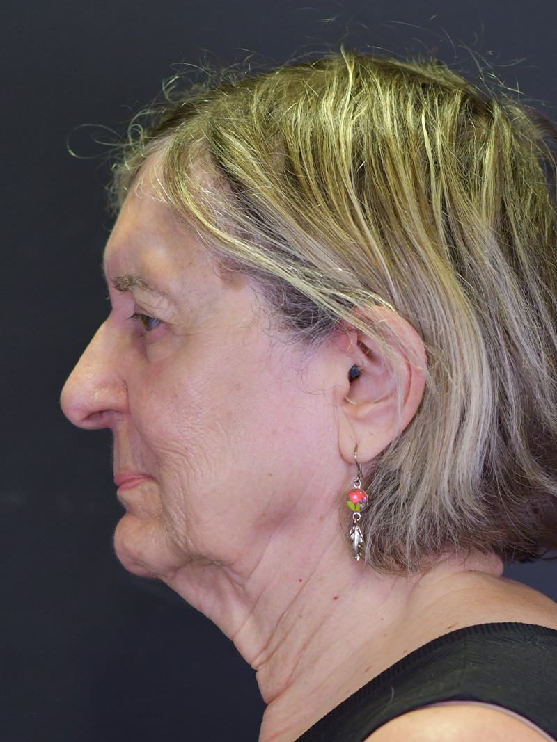 Neck Liposuction Before and After | Northside Plastic Surgery