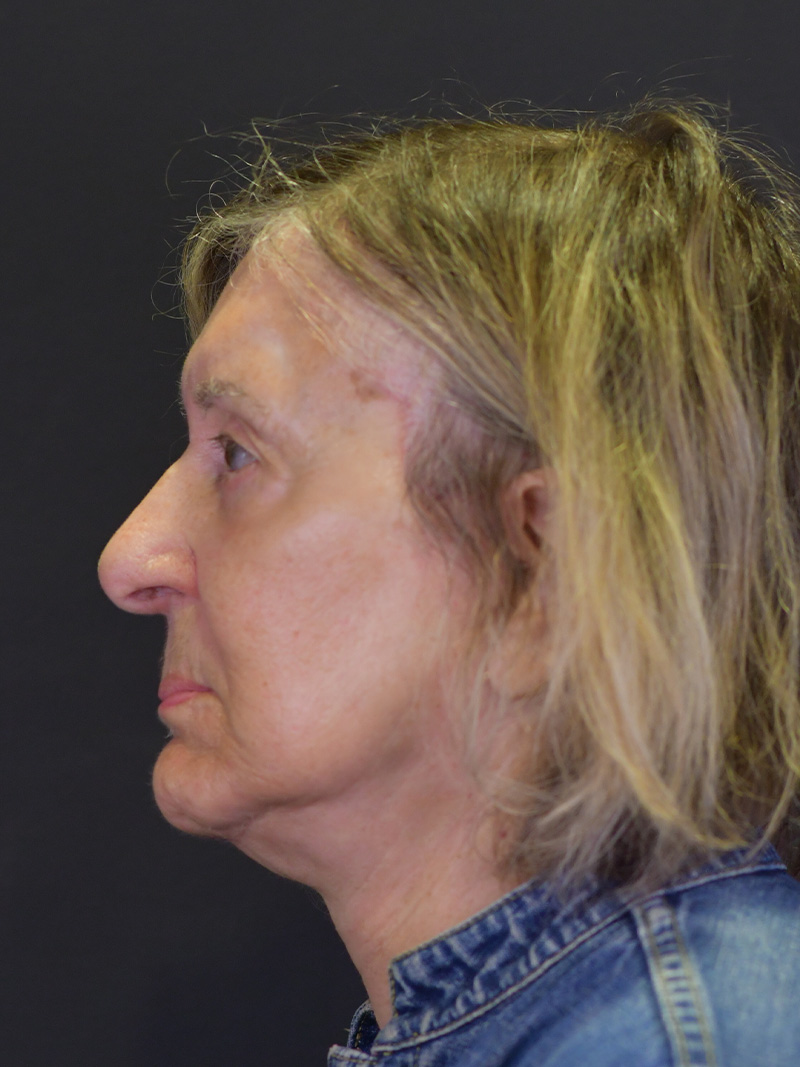 Neck Liposuction Before and After | Northside Plastic Surgery