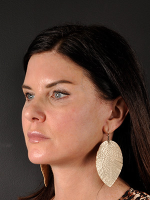 Neck Liposuction Before and After | Northside Plastic Surgery