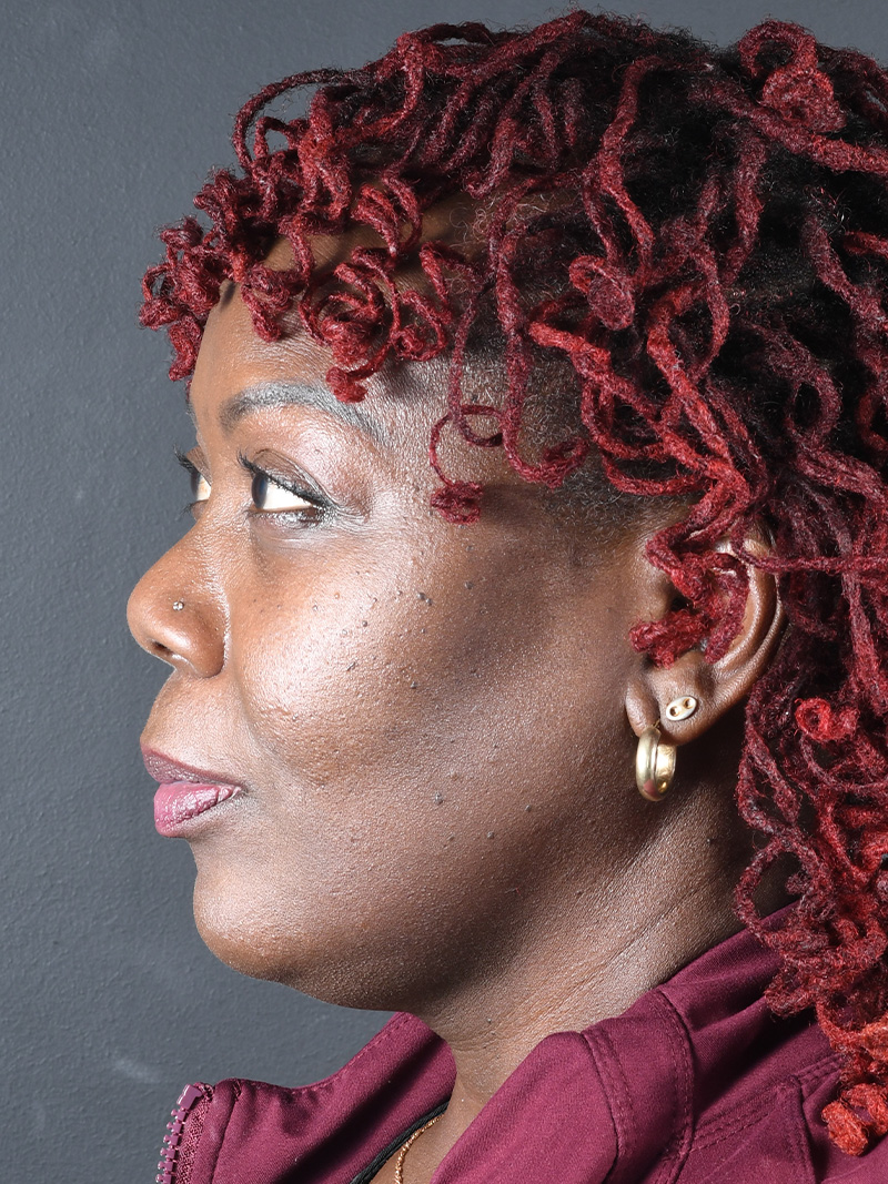 Neck Liposuction Before and After | Northside Plastic Surgery