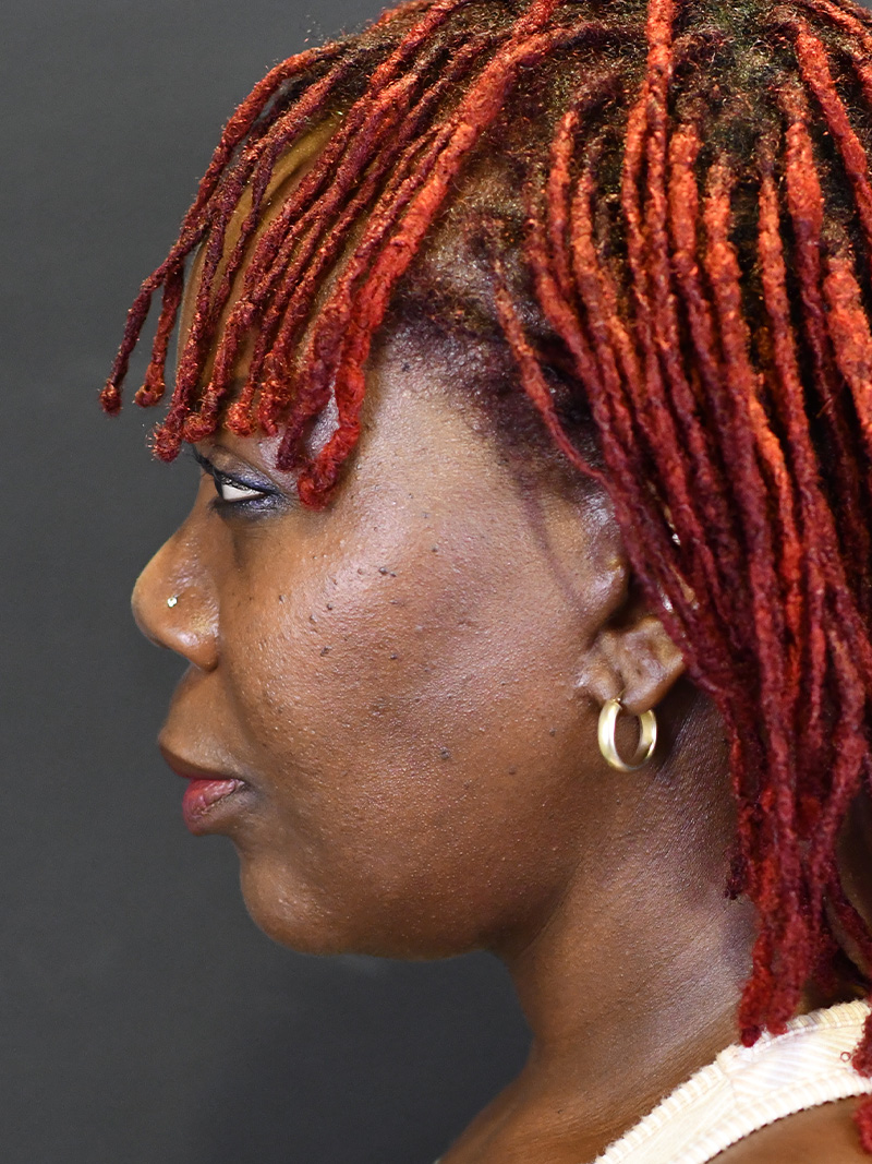 Neck Liposuction Before and After | Northside Plastic Surgery