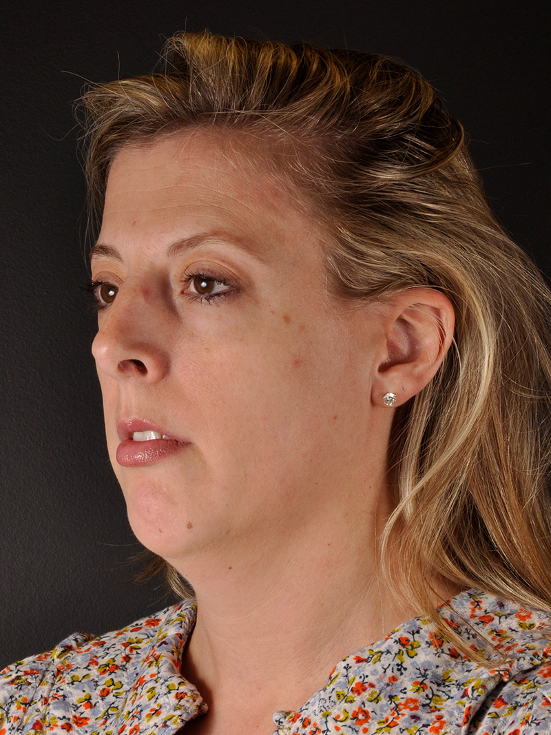 Neck Liposuction Before and After | Northside Plastic Surgery