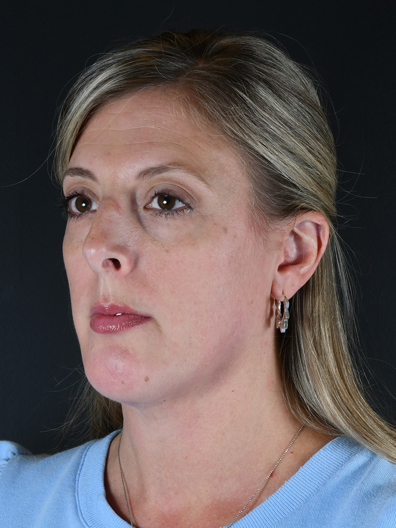 Neck Liposuction Before and After | Northside Plastic Surgery