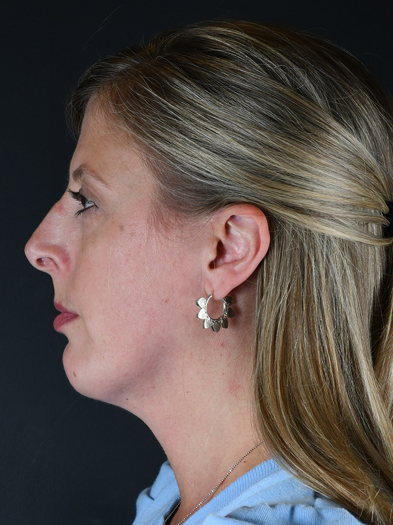 Neck Liposuction Before and After | Northside Plastic Surgery